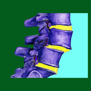 acute spondylolisthesis