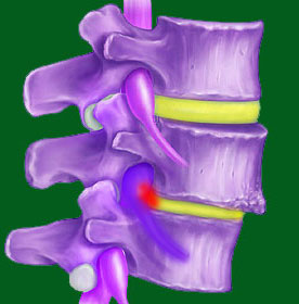 Can spondylolisthesis cause a herniated disc