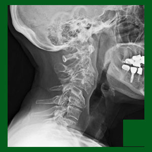 Cervical spondylolisthesis