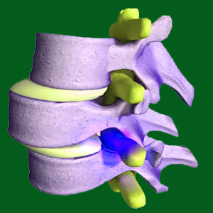 Chronic spondylolisthesis