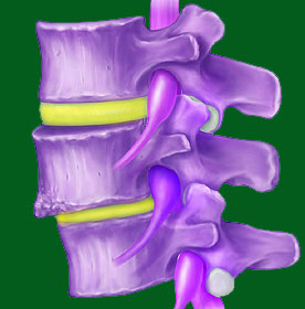 Congenital Spondylolisthesis