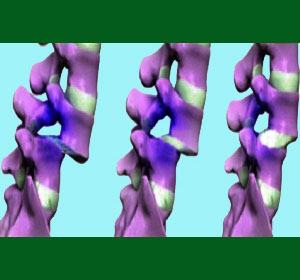 Consequences of Spondylolisthesis