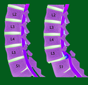 Degenerative spondylolisthesis