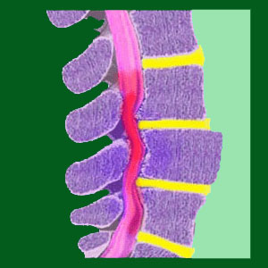 Grade 1 spondylolisthesis