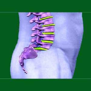 Lumbar spondylolisthesis