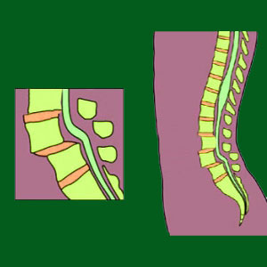 Multiple Spondylolisthesis