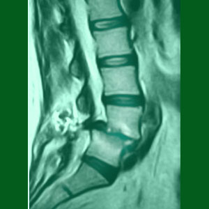 Obesity and Spondylolisthesis