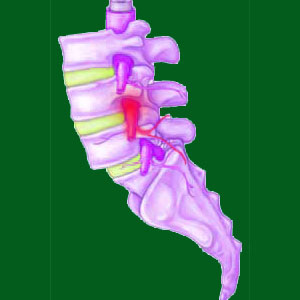 pinched nerve from spondylolisthesis