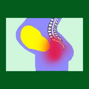 Spondylolisthesis and Pregnancy