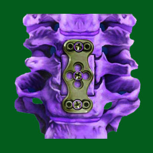 Spinal Fusion for Spondylolisthesis