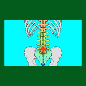 Spondylolisthesis L5