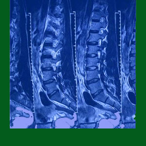 Spondylolisthesis MRI