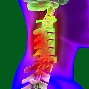 Spondylolisthesis C6