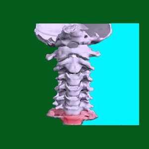 Spondylolisthesis C7