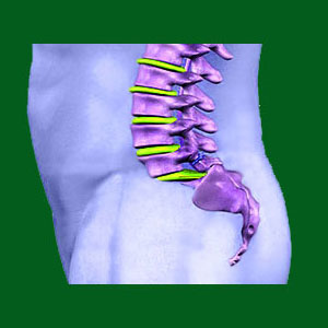 spondylolisthesis definition