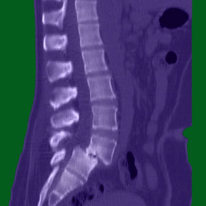 Spondylolisthesis Diagnosis