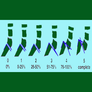 Spondylolisthesis grading