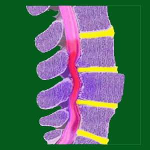 Spondylolisthesis in Children