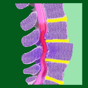 Spondylolisthesis Nerve Damage
