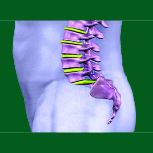 spondylolisthesis nocebo