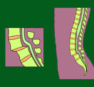 Spondylolisthesis Products