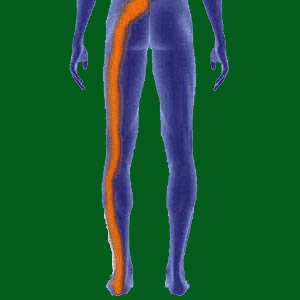 Spondylolisthesis Sciatica