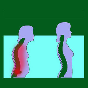 Spondylolisthesis spinal instability