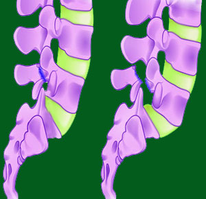 Spondylolisthesis Symptoms