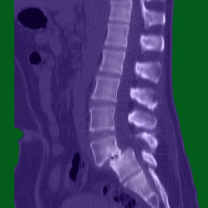 spondylolisthesis x-ray