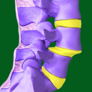 What is Spondylolisthesis?